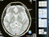 Denne simple råvare i dit køleskab kan potentielt forebygge Alzheimers